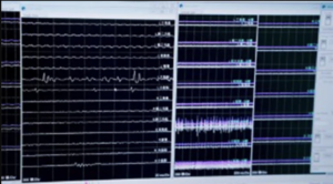 Intraoperative neurophysiological monitoring (IOM)